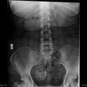Image result for Uterine Fibroid X-ray