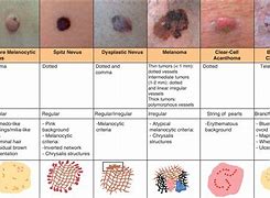 Image result for Squamous Cell Carcinoma Skin Staging