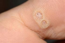 Image result for Warts On Top of Feet