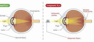 Image result for Eye Astigmatism Lights