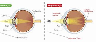 Image result for Astigmatisma