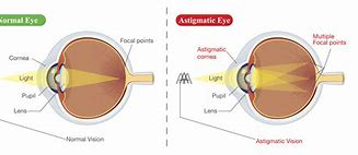 Image result for Inside View of Eye with Astigmatism