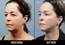 Image result for Cheek Lift
