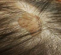 Image result for Scalp Warts