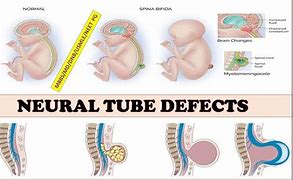 Image result for Pathology Anencephaly