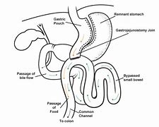 Image result for Gastric Bypass Surgery Omega Loop