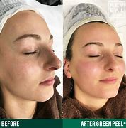 Image result for What Is a Green Peel