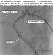 Image result for PTC Biliary Drain