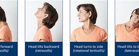 Image result for Jaw Dystonia