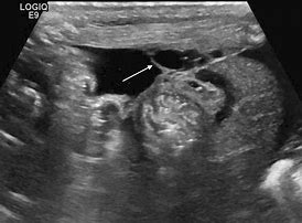 Image result for Necrotic Fibroid Ultrasound