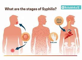 Image result for Dying of Syphilis