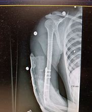 Image result for Broken Bones Healing Crooked