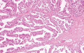Image result for Papilloma Brain Tumor