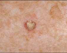 Image result for Dry Scaly Skin Cancer