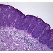 Image result for Chondaloma Vaginal