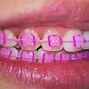 Image result for Braces Colors Pastel Pink