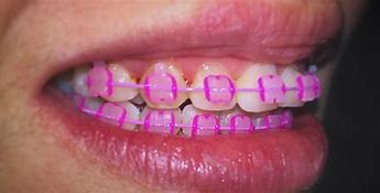 Image result for Braces with Pink Bands