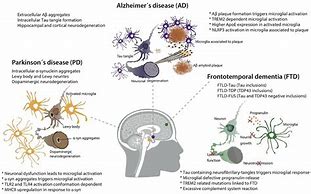 Image result for Brain Shrinking Disease Symptoms