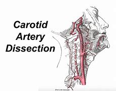 Image result for What Is Carotid Artery Dissection