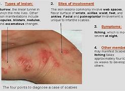 Image result for Scabies Chest