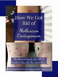 Image result for Molluscum Contagiosum Treatment for Babies