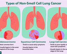 Image result for Two Main Types of Lung Cancer
