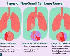 Image result for 4 Types of Lung Cancer