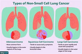 Image result for Large Cell Lung Cancer