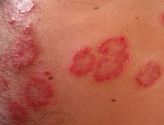 Image result for Systemic Allergic Reaction Rash