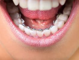 Image result for Braces Inside Teeth