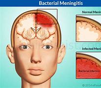 Image result for Meningitis