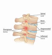 Image result for Bone Spurs Spine