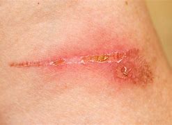 Image result for White Scab