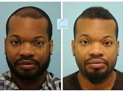 Image result for African American Hair Transplant
