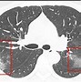 Image result for COVID-19 causes