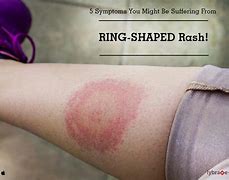 Image result for Red Circle Allergy
