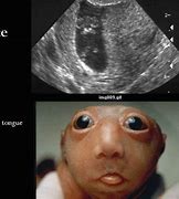 Image result for Anencephaly Ultrasound Frog Eye Appearance