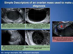 Image result for ovarian cyst ultrasound
