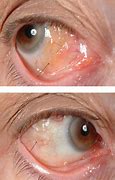 Image result for Conjunctival Granuloma Eye