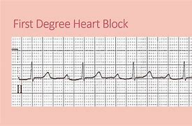 Image result for Type 1 vs Type 2 Heart Block