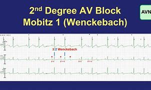 Image result for Mobitz Type 1 vs 2