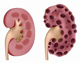 Image result for Lower Pole of Kidney Cyst