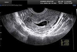 Image result for Transvaginal Ultrasound 4 Weeks