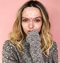 Image result for Pretty Acne Face