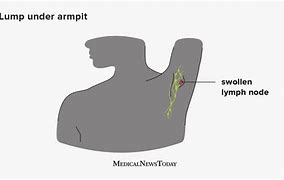 Image result for 1 Cm Lump