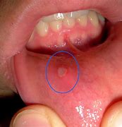 Image result for Allergic Reaction in Mouth