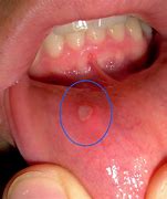Image result for Mouth Ulcer