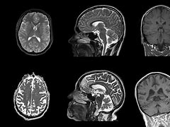 Image result for Normal Shrinking of the Brain