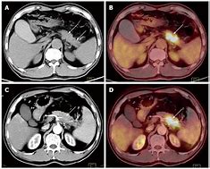 Image result for Pet Scan Pancreatic Cancer
