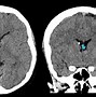 Image result for Tuberous Sclerosis Brain